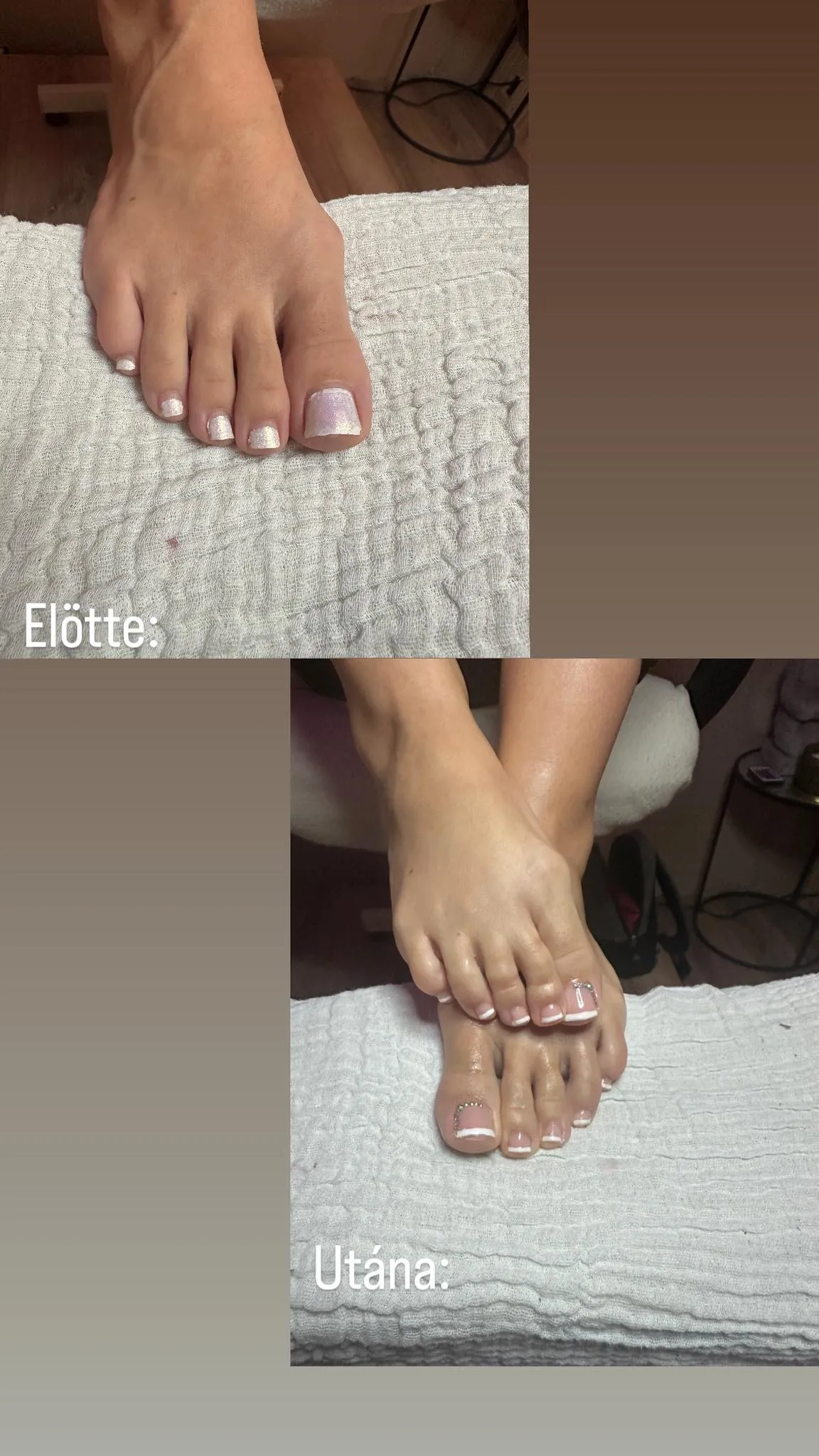 Előtte-utána — pedikűr kezelés